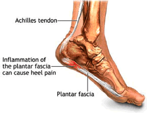 Plantar Fasciitis