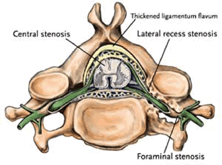 Spinal Stenosis