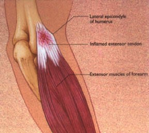 Lateral Epicondylitis (Tennis Elbow)
